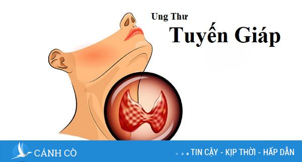 Căn bệnh ung thư tuyến giáp mà Hoài Linh mắc nguy hiểm cỡ nào?