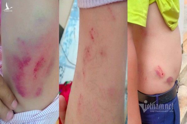 Các vết thương trên người ông Thủy do bị đánh 
