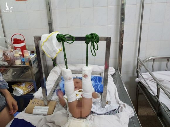 Con trai 4 tháng tuổi nghi bị cha ruột ‘chơi đá’ đánh đến xuất huyết não, gãy chân - ảnh 2