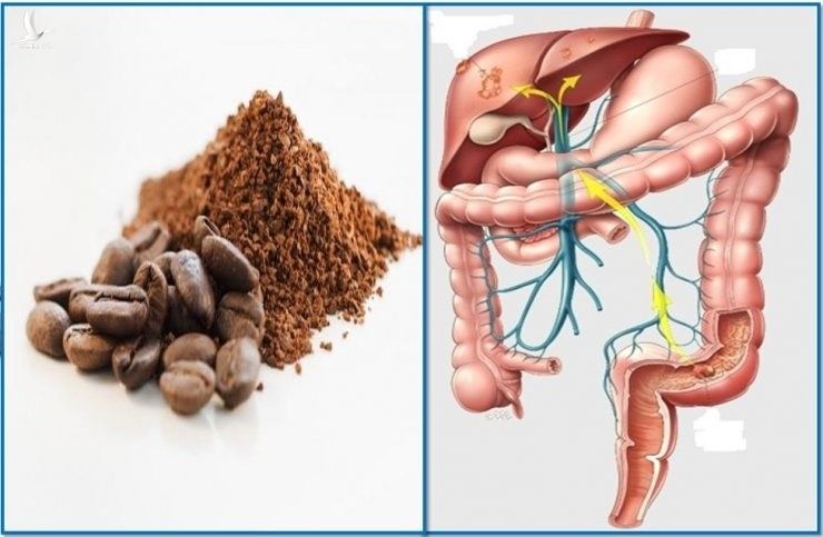 Thải độc đại tràng bằng cà phê Thải độc đại tràng bằng cà phê