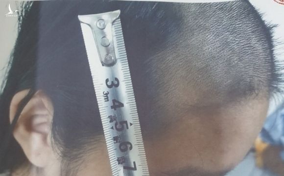 Bé gái ở Bắc Ninh bị cha đánh đập nhiều ngày, dùng tông đơ cạo tóc