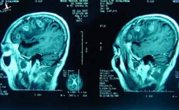 Hình ảnh CT não của cháu bé ngã từ tầng 13 chung cư không có tổn thương, BS thốt lên "Tôi không thể tưởng tượng..."