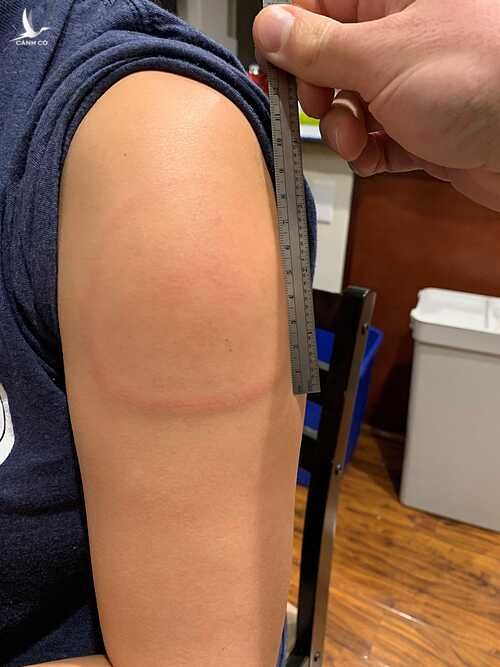 Vết phát ban cánh tay dài 15cm ở người tiêm vaccine Moderna. Ảnh: Mass General Brigham Hospital