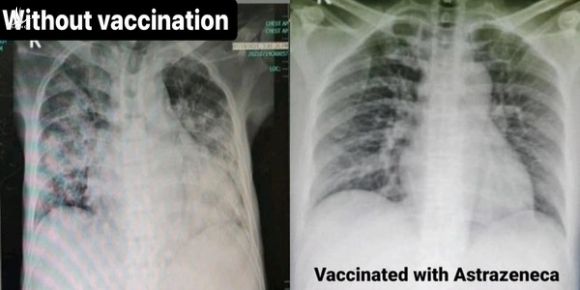 4 bức ảnh chụp phổi của bệnh nhân Covid-19 đã tiêm các loại vắc xin khác nhau và không tiêm: Kết quả gây sốc! - Ảnh 1.