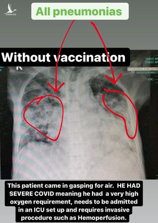 4 bức ảnh chụp phổi của bệnh nhân Covid-19 đã tiêm các loại vắc xin khác nhau và không tiêm: Kết quả gây sốc! - Ảnh 3.