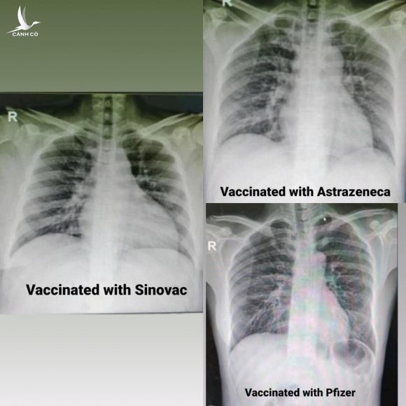4 bức ảnh chụp phổi của bệnh nhân Covid-19 đã tiêm các loại vắc xin khác nhau và không tiêm: Kết quả gây sốc! - Ảnh 2.