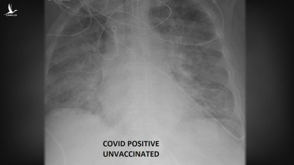 So sánh ảnh chụp phổi của bệnh nhân COVID-19 đã tiêm và chưa tiêm vaccine, phát hiện điều kinh ngạc - Ảnh 1.