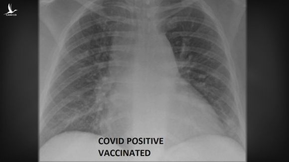 So sánh ảnh chụp phổi của bệnh nhân COVID-19 đã tiêm và chưa tiêm vaccine, phát hiện điều kinh ngạc - Ảnh 2.