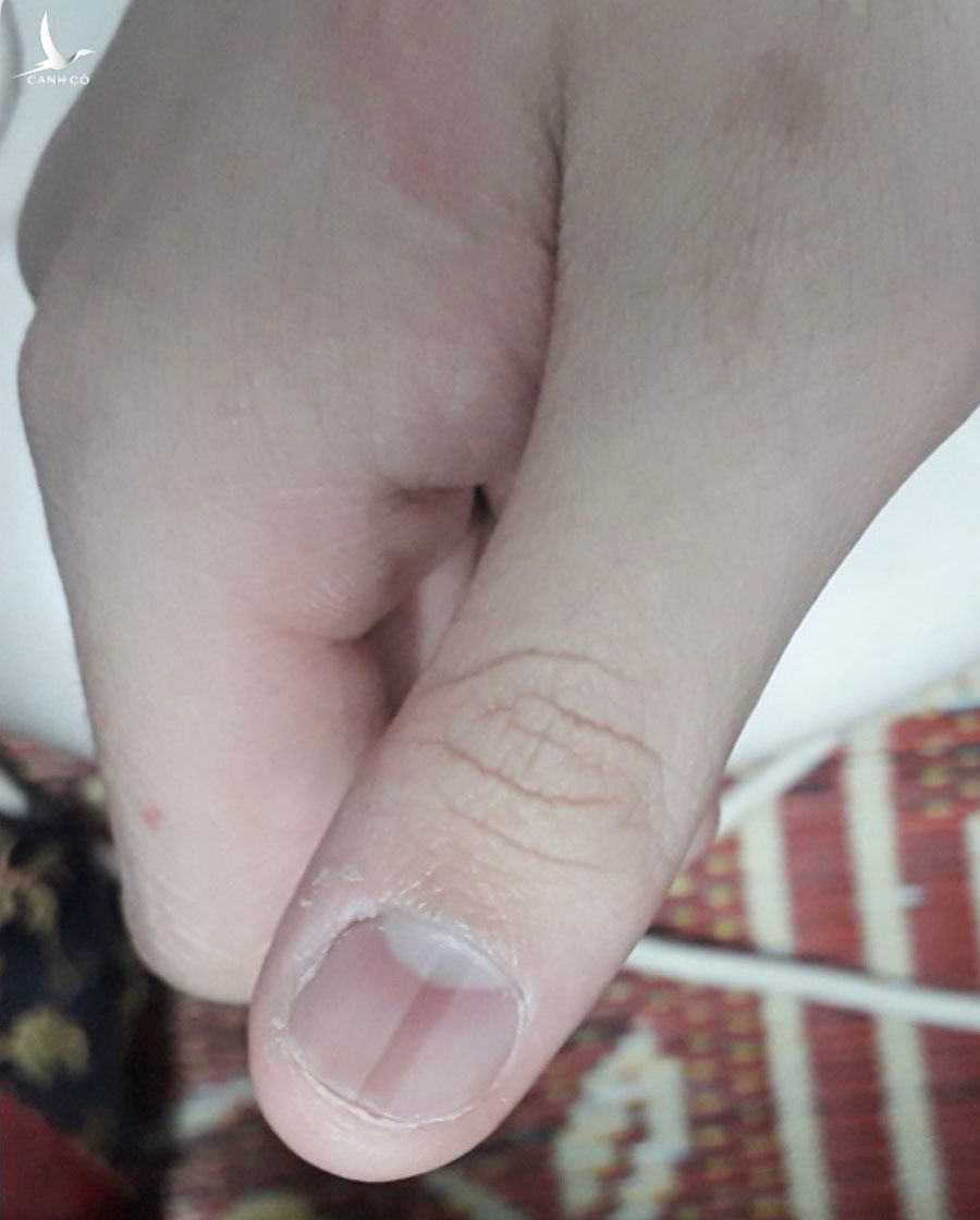 Bác sĩ Hà Nội kể về dấu hiệu lạ trên móng tay bệnh nhân Covid-19