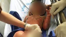 Vụ cô giáo đốt cồn dạy cháy nổ, 3 trẻ bị bỏng tiên lượng xấu