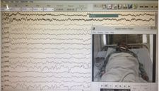 Nghi vấn BV Bạch Mai “cắt xén” thời gian điện não video cho BN tâm thần