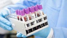Phương pháp xét nghiệm máu phát hiện sớm 5 bệnh ung thư