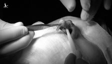 Đứt trụ mũi do ‘bác sĩ Sài Gòn’ làm đẹp tận nhà