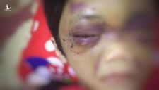 Bé gái 6 tuổi ở Hải Dương bị mẹ bạo hành thâm tím mặt