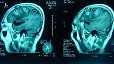 Hình ảnh CT não của bé gái rơi từ tầng 13 khiến bác sĩ não vô cùng bất ngờ