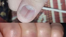 Bác sĩ Hà Nội cảnh báo về dấu hiệu lạ trên móng tay của bệnh nhân Covid-19