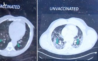 Hiệu quả của vắc xin Covid-19 qua hình ảnh chụp phổi của bệnh nhân