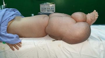 Kỳ tích cắt bỏ khối u ‘khủng’ hơn 42 kg ra khỏi chân bệnh nhân