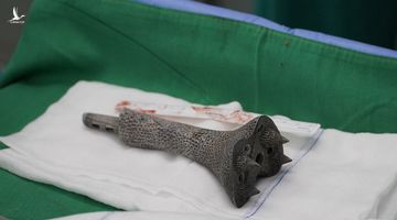 Bệnh viện Chợ Rẫy dùng Titanium in 3D trám lỗ hổng 11cm ở xương bệnh nhân ung thư