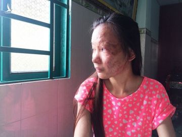Tội phạm với axit để lại những di chứng nặng nề cho nạn nhân /// Ảnh: Phạm Hữu