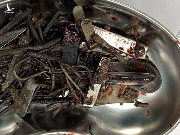 Ngoạn mục cứu sống người đàn ông Bình Dương ăn gần 1kg dị vật kim loại 3