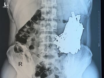 Ngoạn mục cứu sống người đàn ông Bình Dương ăn gần 1kg dị vật kim loại 5