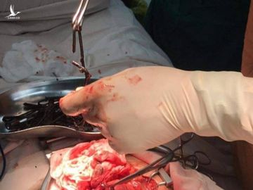 Ngoạn mục cứu sống người đàn ông Bình Dương ăn gần 1kg dị vật kim loại 4