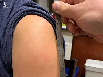 Vết phát ban cánh tay dài 15cm ở người tiêm vaccine Moderna. Ảnh: Mass General Brigham Hospital