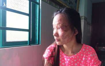 Nỗi đau axit: Nên quy định axit là ‘công cụ phạm tội đặc biệt’
