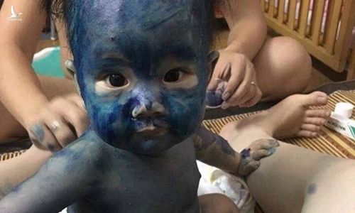 Sự thật về hai loại thuốc xanh, đỏ người mắc thủy đậu hay dùng