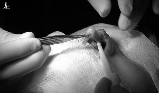 Đứt trụ mũi do ‘bác sĩ Sài Gòn’ làm đẹp tận nhà