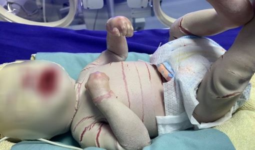 Thương tâm bé trai sơ sinh mắc bệnh vẩy trắng toàn thân hiếm gặp