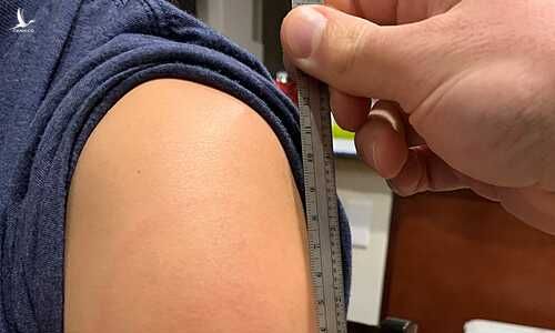 ‘Cánh tay Covid’ – triệu chứng vô hại sau tiêm vaccine Moderna