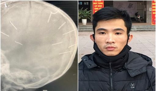 4 lần tra tấn, hành hạ bé gái 3 tuổi của gã nhân tình bị câm điếc