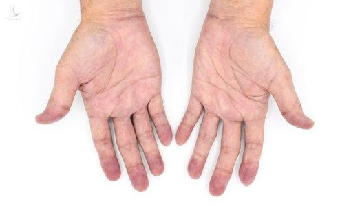 Nhiễm Omicron mà gặp những dấu hiệu này, gọi cấp cứu ngay!