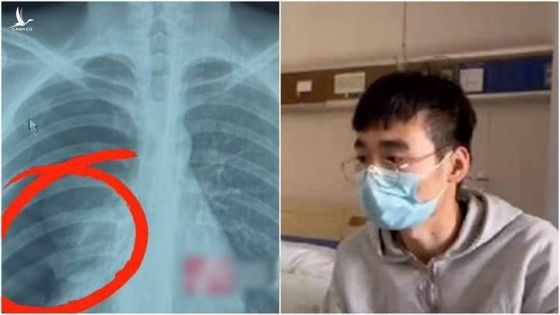 Vỡ phổi vì hát karaoke quá sung